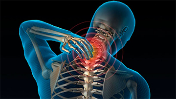 Dolor Cervical