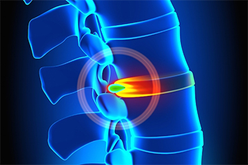Hernia Discal