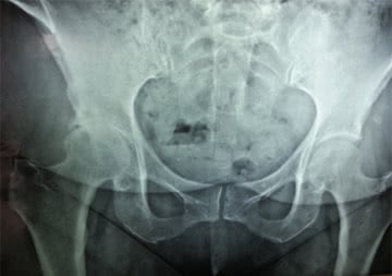 Lumbalgia